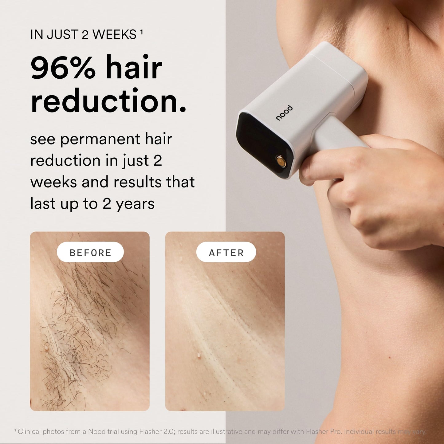 Nood Flasher Pro IPL Hair Removal Device with Slow Grow Serum Kit White